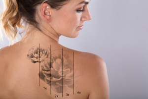 Laser Tattoo Removal On Woman’s Shoulder Medizinische Lasertechnologie